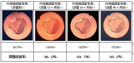 赤錆閉塞を確認する内視鏡調査写真 設置前の赤錆閉塞率30.7% 設置後12ヶ月の赤錆閉塞率19.6% 設置後24ヶ月の赤錆閉塞率18.5% 設置後45ヶ月の赤錆閉塞率15.3% と、最終的に赤錆閉塞の改善率は、50.2%に